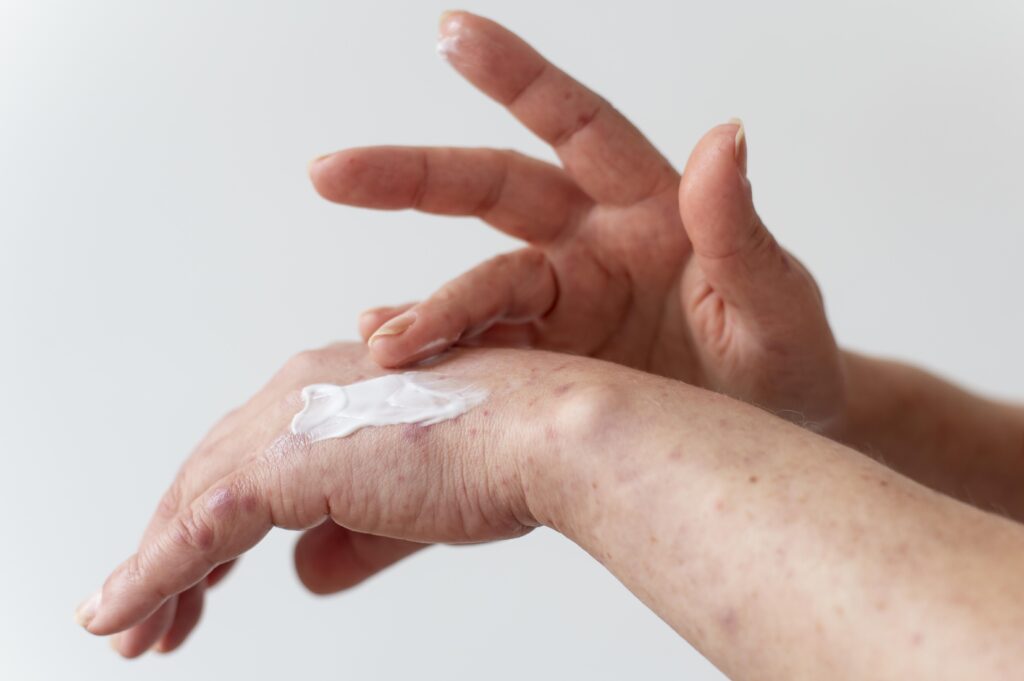 Dermatites e Hidratação de pele
